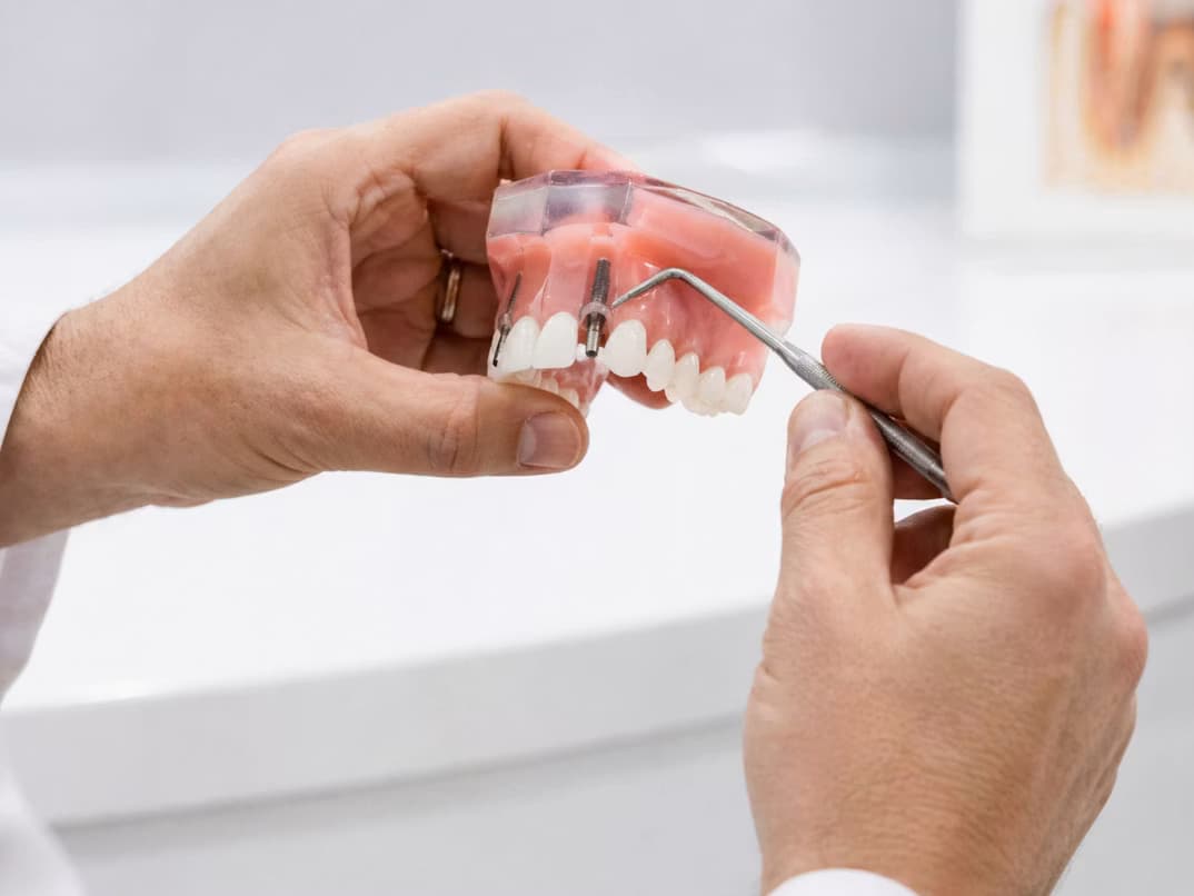 Implantes dentales en Rincón de Milberg