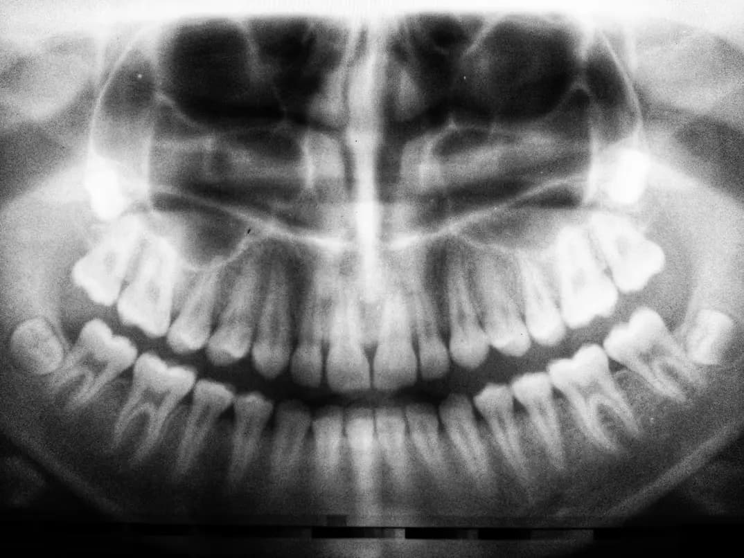Odontología digital (escáner intraoral e impresora 3D) en Rincón de Milberg